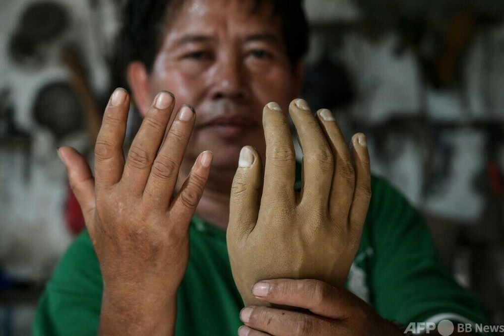 差別の痛みを糧に義肢製作 インドネシアのハンセン病元患者