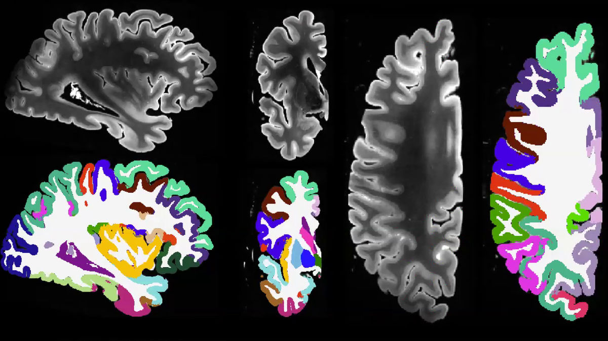 7テスラのMRIで生体外脳組織標本の高解像度データセットを生成、皮質領域の区分化にも成功