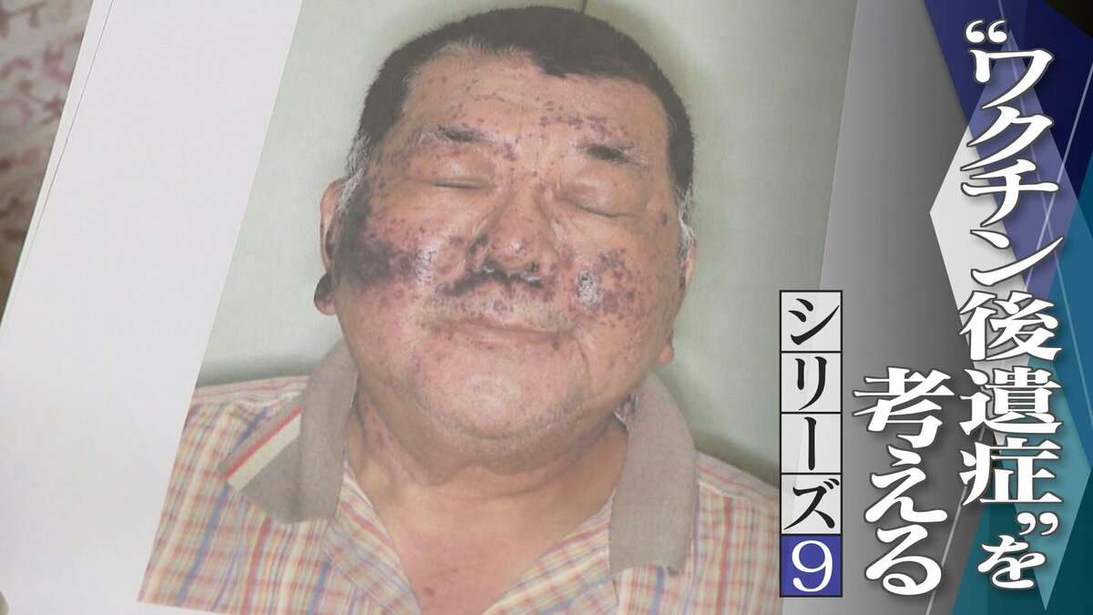 新型コロナワクチン接種の半月後、夫に異変 難病を発症し死亡